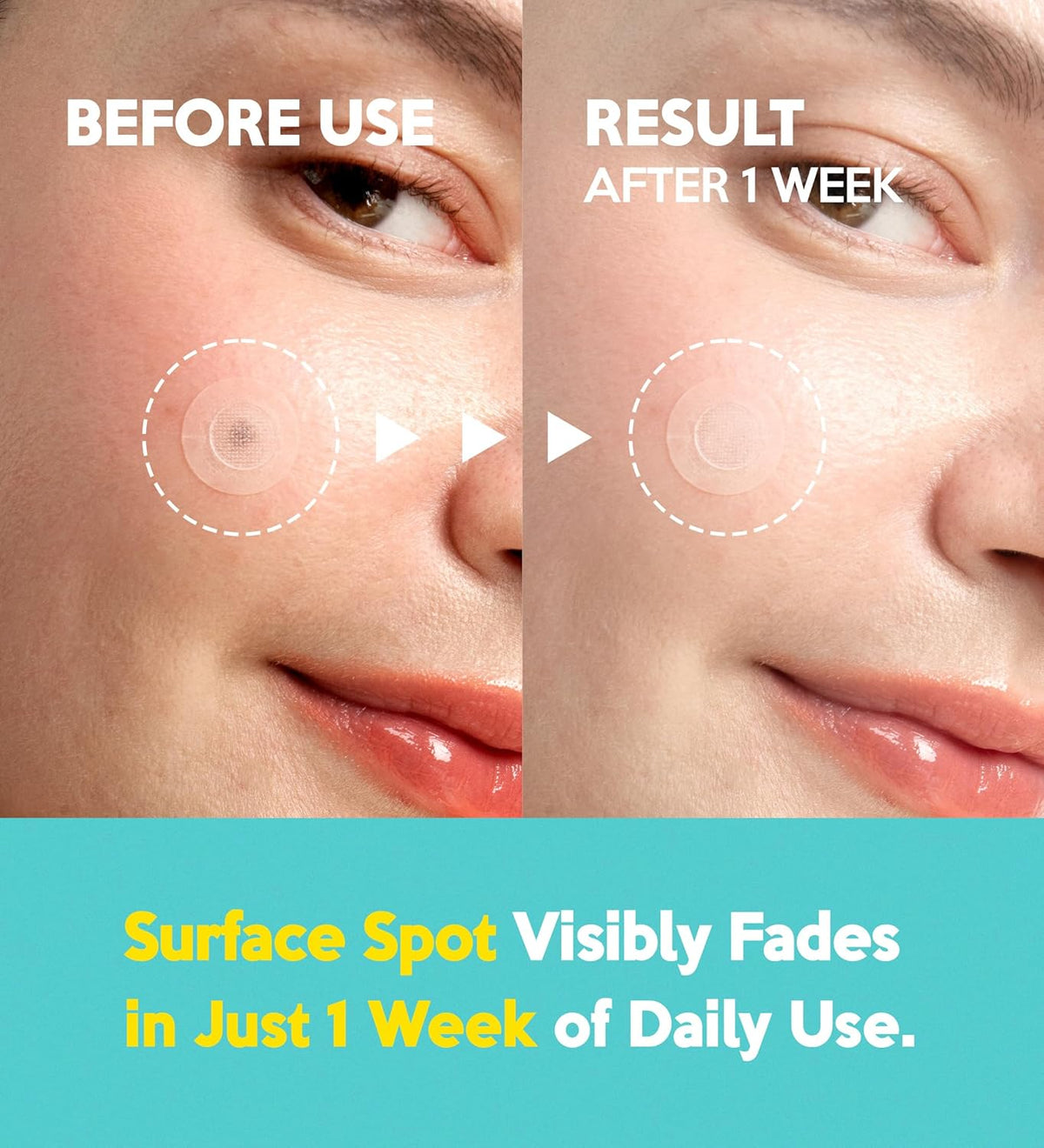 Troubless Micro-Point Patch Plus Vitamin C 10% For Dark Spot