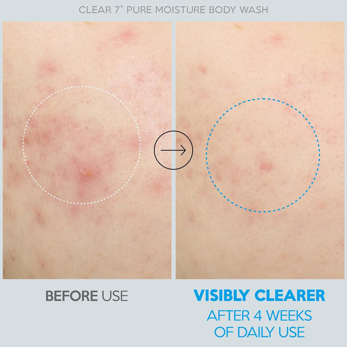Troubless Clear 7 Plus Pure Moisture Body Wash